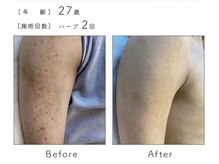 チップ(chip)/27歳／施術2回