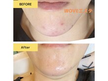 サバス(Sabbath)/MIBエステでくすみ・シミケア