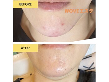 サバス(Sabbath)/MIBエステでくすみ・シミケア