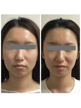 ベルナ(BELUNA)/Before After