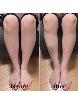 あした葉 カイロプラクティック/☆フットむくみケア☆