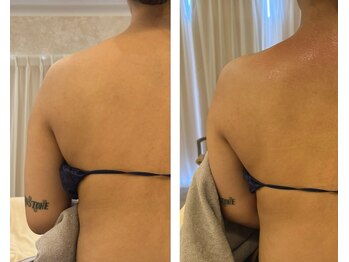 エイミー(Aimee)/【炭酸パック】ビフォーアフター