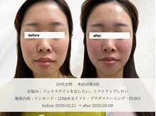 エメ(aimer)/LiftCare《小顔・リフトアップ》