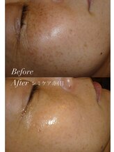 #美容革命ラボ 福岡春吉店 シミケア 激変