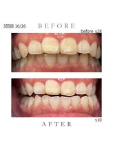 エンルーチェ プラスエイト(en;Luce+8)/ホワイトニング3回