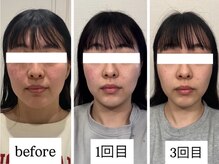 マカオン(machaon)/【小顔リフト】小顔マッサージ