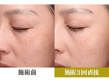 ルアナ 武蔵小杉店(Luana)/シミケア　光フェイシャル　