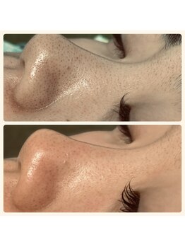 アイラッシュ ミル 御領店(eye lash Miru)/肌質改善毛穴ケア