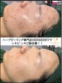 ハーバリー ハーブピーリング 岐阜(HERBERRYハーブピーリング) 【剥離あり】リベルハーブピーリングならニキビ跡にも効果発揮◎