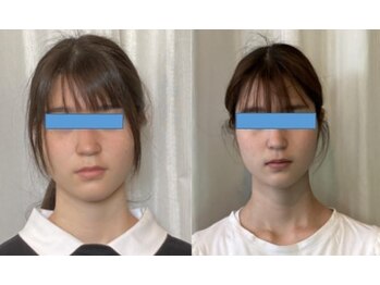 やえざきカイロプラクティック/小顔美容矯正矯正bfore＆afuter