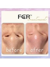 シャルム ココ 八尾店(Charme coco)/毛穴・黒ずみケア　１回目