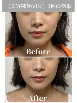 サンクエール 代官山鍼灸院(CINQ AILES)/美容鍼　リフトアップ・小顔