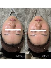 ラ フルール(La Fleur)/エアバリフェイシャル