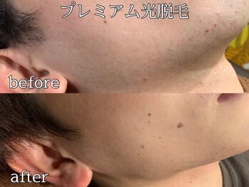 MMA/プレミアム光脱毛【ひげ】