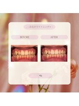 プラスビーセルフ(+b self)/ホワイトニングビフォーアフター