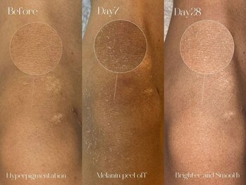 韓国肌管理yeoun【ヨウン】ROMAPINK/黒ずみ/毛穴/プラピール/ララピール福岡天神/ローマピンク福岡/メラニンケア