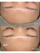 アエ(ae)/ダクトピール