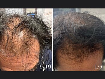 キュライム 熊本(CURAIM)/育毛促進【60代男性】