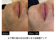 ダイヤ 名古屋中川区店(Daiya)/【横顔の変化実例】3回経過