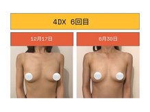 美〇工房 心斎橋店(B-Labo)/離れ乳がお悩みの方［バストケア