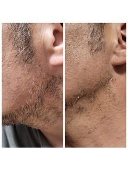 ビューティー サロン アイビー(Ivy)/ひげ脱毛