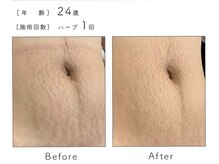 チップ(chip)/24歳／施術1回