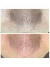 ルナート(Lunart)/毛穴洗浄／毛穴ケア