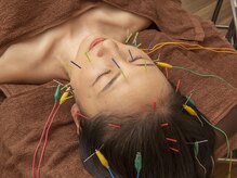 長寿鍼灸院 長寿整骨院/美容鍼鍼通電中