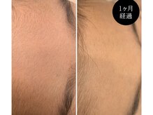 エルマナ(HERMANA)/フェイス脱毛/顔脱毛/毛穴