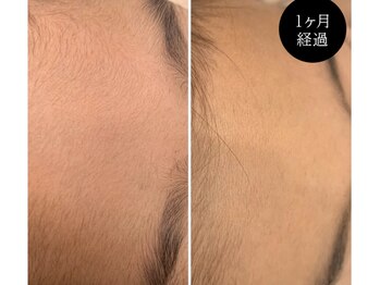 エルマナ(HERMANA)/フェイス脱毛/顔脱毛/毛穴