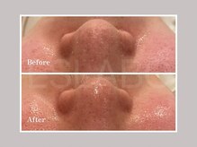 エスラボ オオサカ 心斎橋/毛穴洗浄×カーボキシーパック