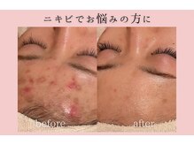 フォーウーマン(for woman)/ピーリング＋パック＋セルサー 