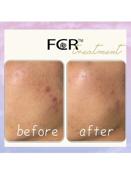 シャルム ココ 八尾店(Charme coco)/ニキビケア　１回目