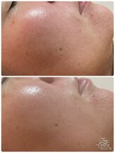 はんなり/ホワイトスノーピーリング