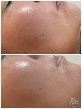 はんなり/ホワイトスノーピーリング