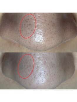 エヌ ドット ジュウイチ(N.11)/黒ずみ毛穴洗浄