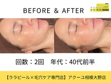 ア クーユ 相模大野店/レモンボトル/二重あご/小顔