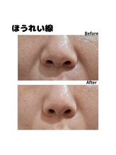 エクラ(e'clat)/ほうれい線にお悩みの方