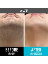 RBL 三重四日市店/メンズ脱毛／ヒゲ脱毛13回目