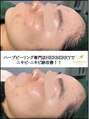 ハーバリー ハーブピーリング 岐阜(HERBERRYハーブピーリング) 【剥離あり】リベルハーブピーリングはニキビ・ニキビ跡に★