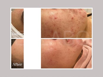 エスラボ オオサカ 心斎橋/毛穴洗浄×剥離ハーブピーリング