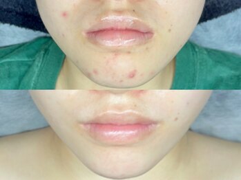 エモーショナル 姫路(Emotional)/ハーブピーリング→ララピール