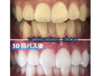 ホワイトニングショップ 三島店(WHITENING SHOP)/10回券終了時before・after♪