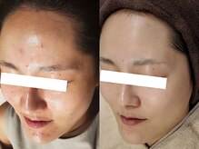 失敗しないハーブピーリングの選び方！徹底したカウンセリングと、効果の出る確かな施術