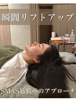 ルデュー 南青山本店(Ledieu)/美容鍼で速攻小顔へ