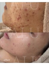 アルフォービューティー 恵比寿店(ALU for beauty)/ニキビ症例