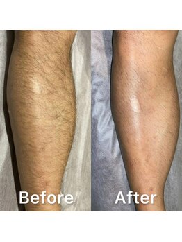 サーティースリー 横浜元町(Thirty3)/【脱毛】Before/After