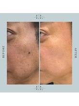 スプレール 水戸店/ExoLif（エクソリフト）