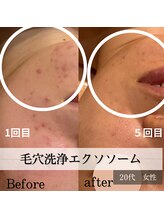 パルティノ 高崎店/毛穴洗浄エクソソーム