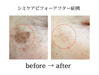 カピリナスパ(Ka.Pilina Spa)/before⇒after